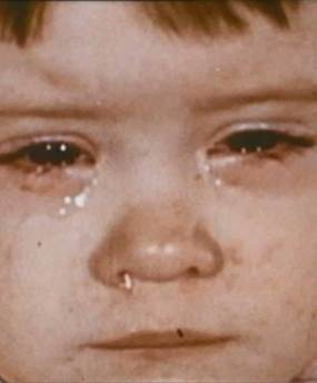 child with measles