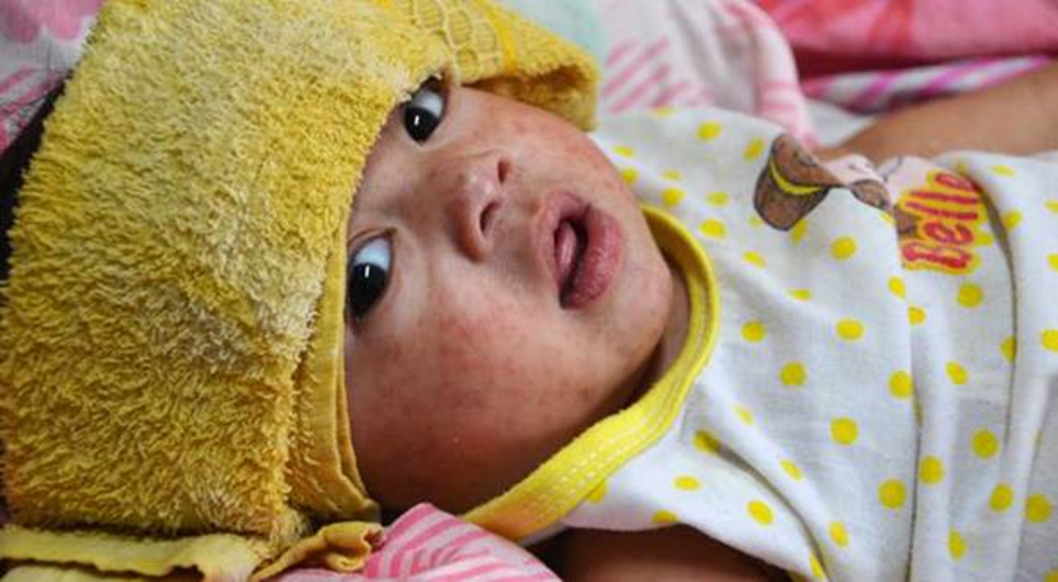 baby with measles rash and washcloth on forehead,  wearing a Disney Princess 'Belle' onesie and looking at the camera